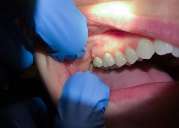 Best Emergency Treatment for Oral Infections in Shenorock, NY